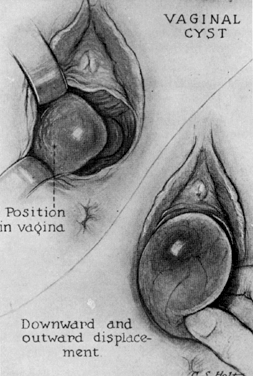 Benign Tumors In Vagina 3