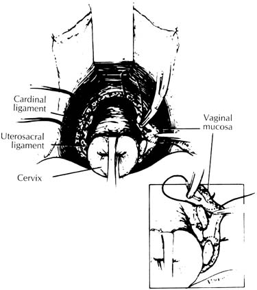 Operations For Support Of The Vaginal Vault Glowm