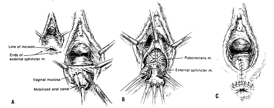 Artificial Anal Sphincter 95