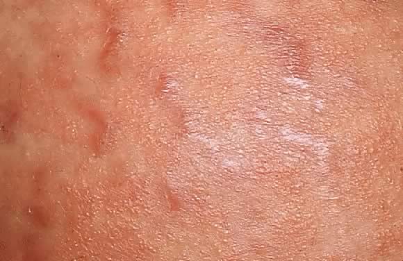 Dermatologic Diseases In Pregnancy Glowm