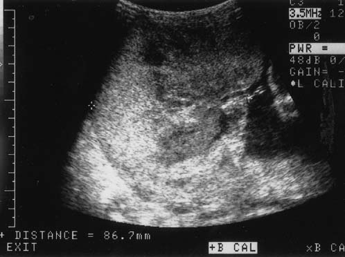 What is a grade 3 placenta?