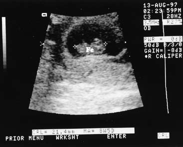 dating scan at 10 weeks