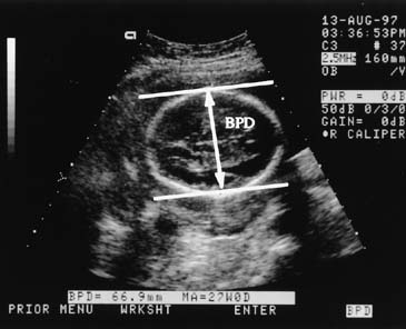 Fetal Bpd Chart In Cm