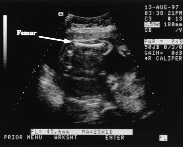 baby measuring small at 39 weeks ultrasound