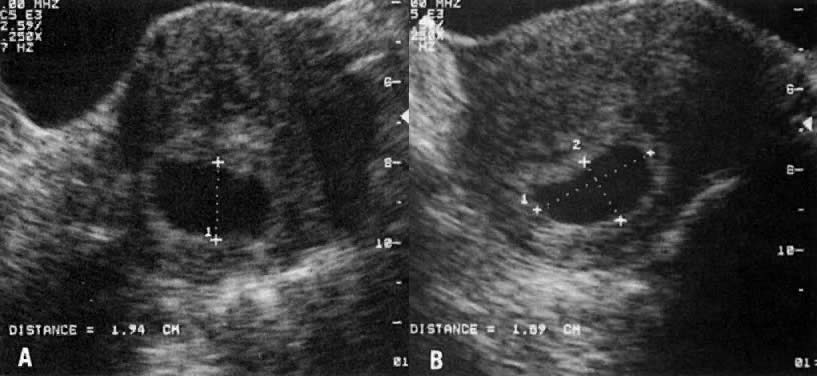 Gestational Sac Mean Size Chart