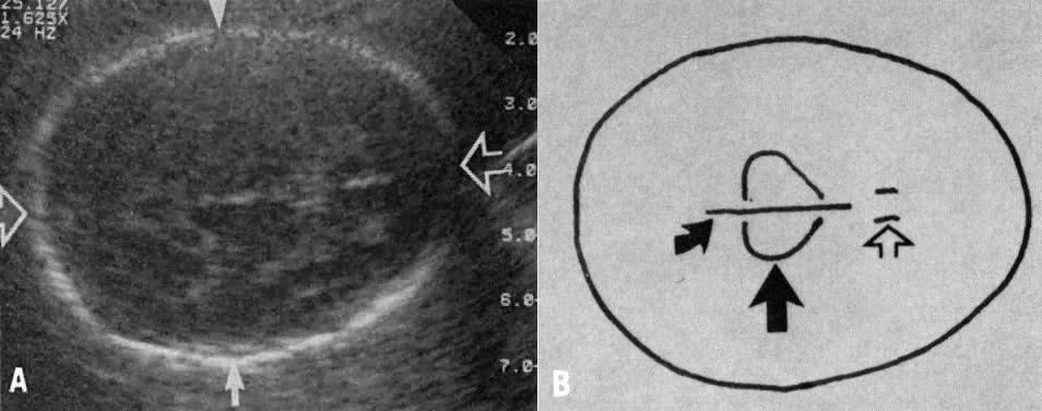 Fetal Bpd Chart In Cm