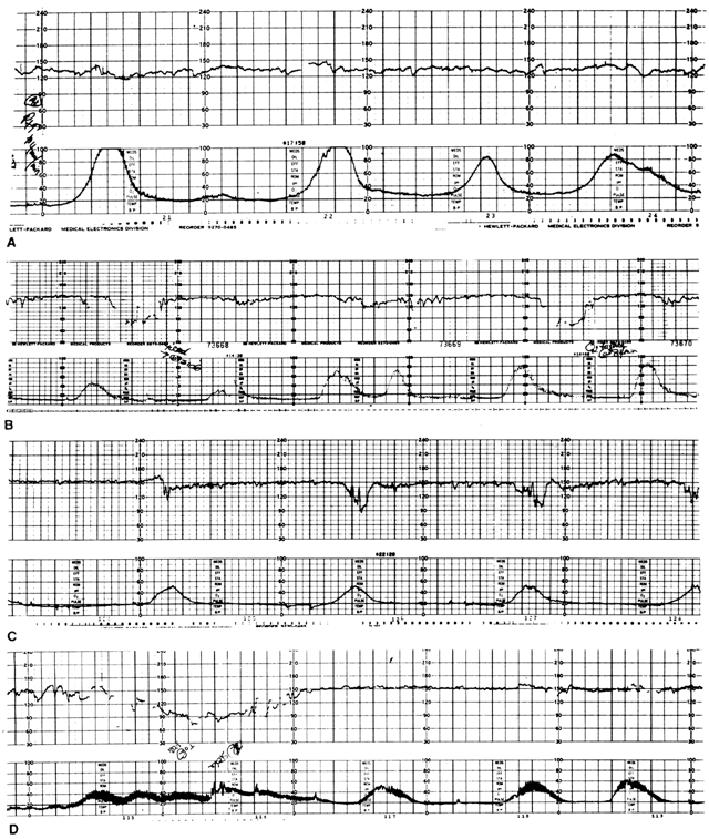 Tracking Contractions Chart