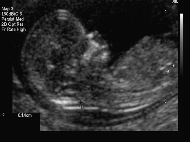 sequential screening with nuchal fold translucency