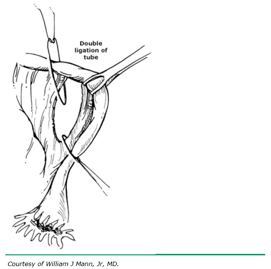 Surgical Procedures For Tubal Sterilization Glowm