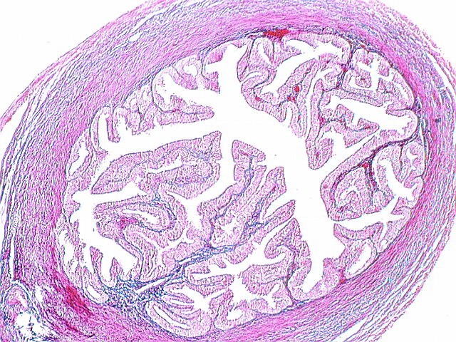 Infundibular Cyst - CAL