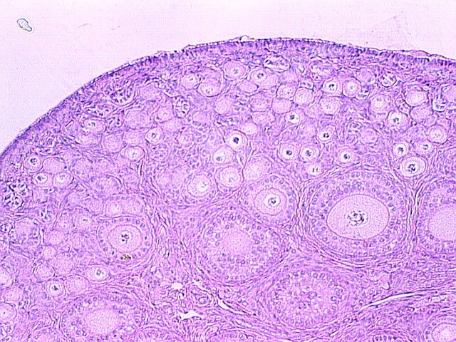 Flat Epithelial Atypia: FEA - Breast Cancer information
