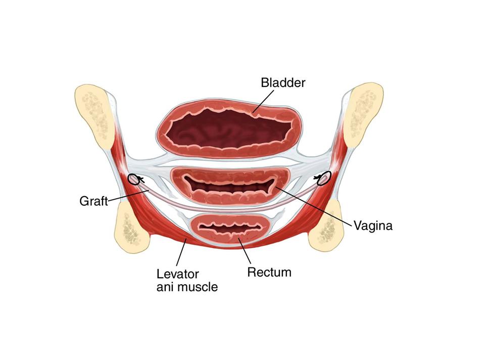 Distension thru vulva