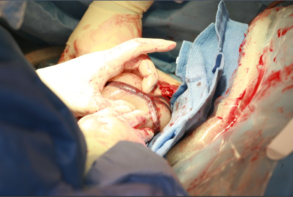 Manual Removal Of Placenta At Caesarean Section