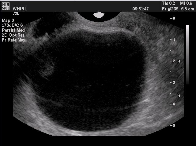 Is pregnancy possible with an ovarian cyst?