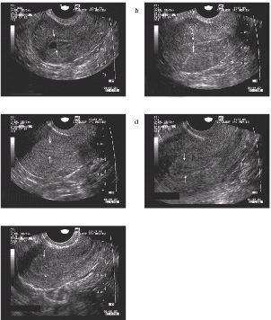 . from the National Institute for Biological Standards and Control, code 75/589..  Associations of initial βhCG, endometrial thickness, and age with pregnancy.  and had a significantly thinner mean endometrial stripe measured by sonography  ... in the diagnosis of early pregnancy failure and the prognosis of fetal viability.