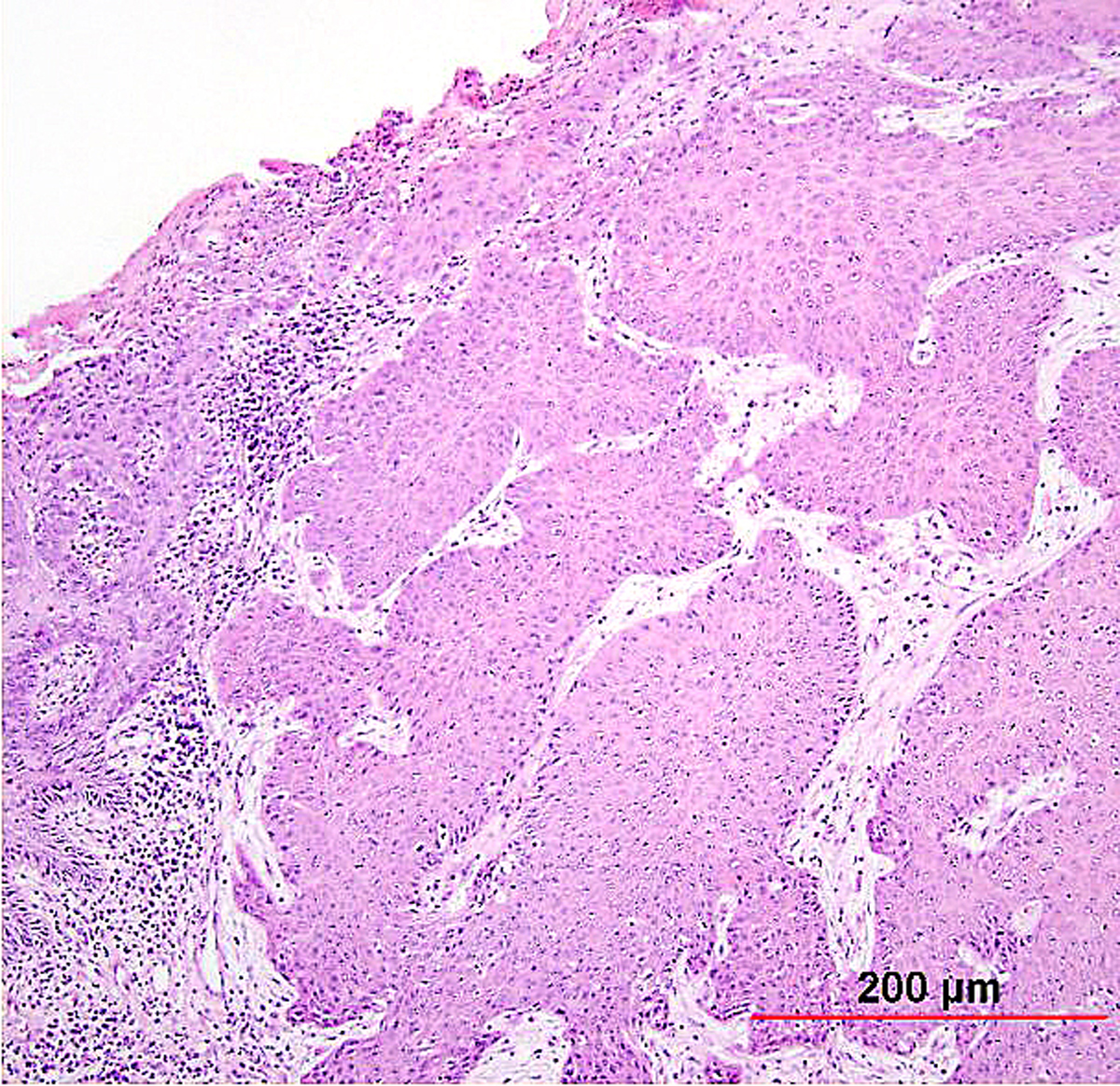 Basal Cell Carcinoma Histology Palisading Nuclei