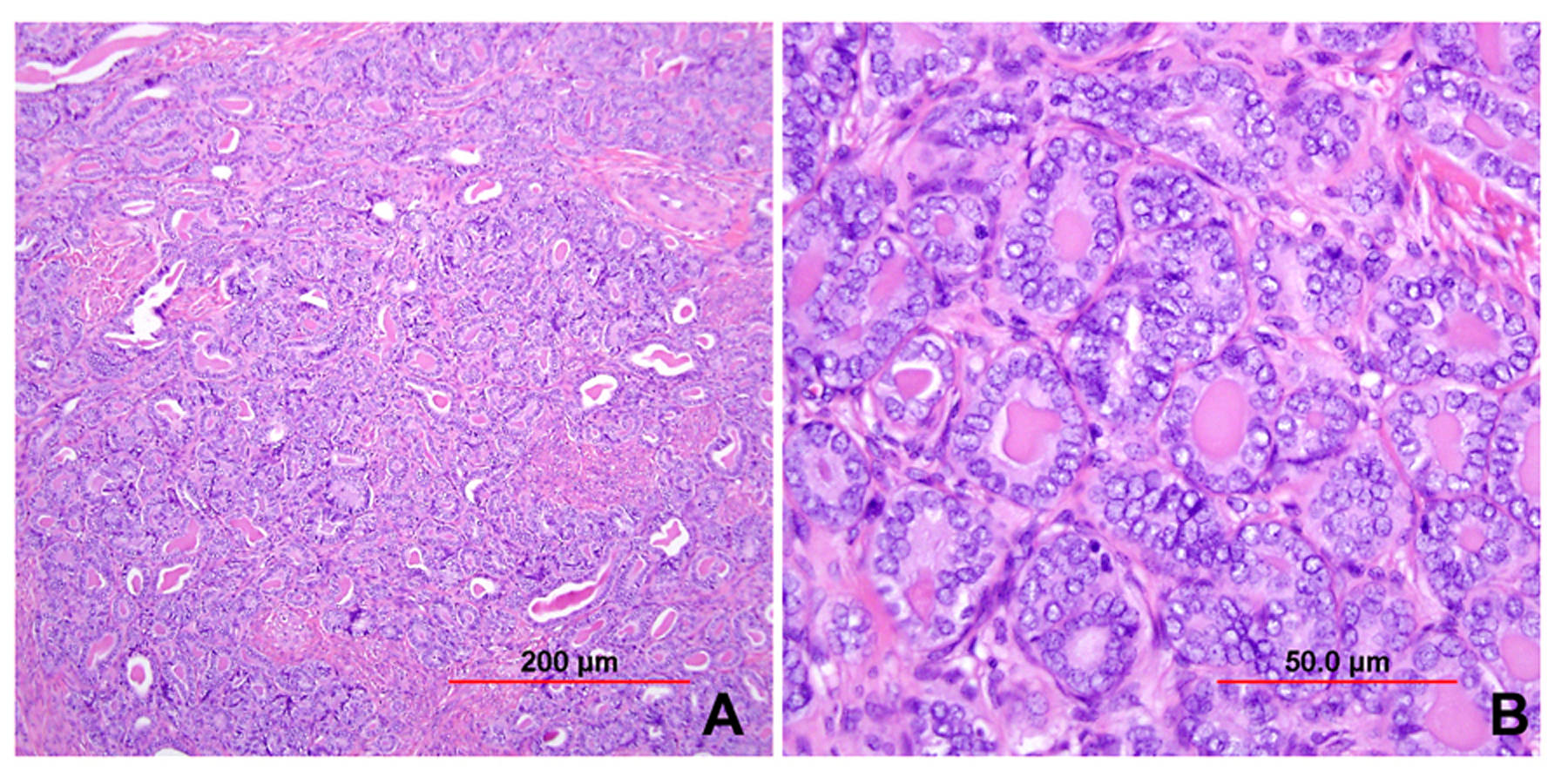 Pathology Of Cervical Carcinoma Glowm 6376