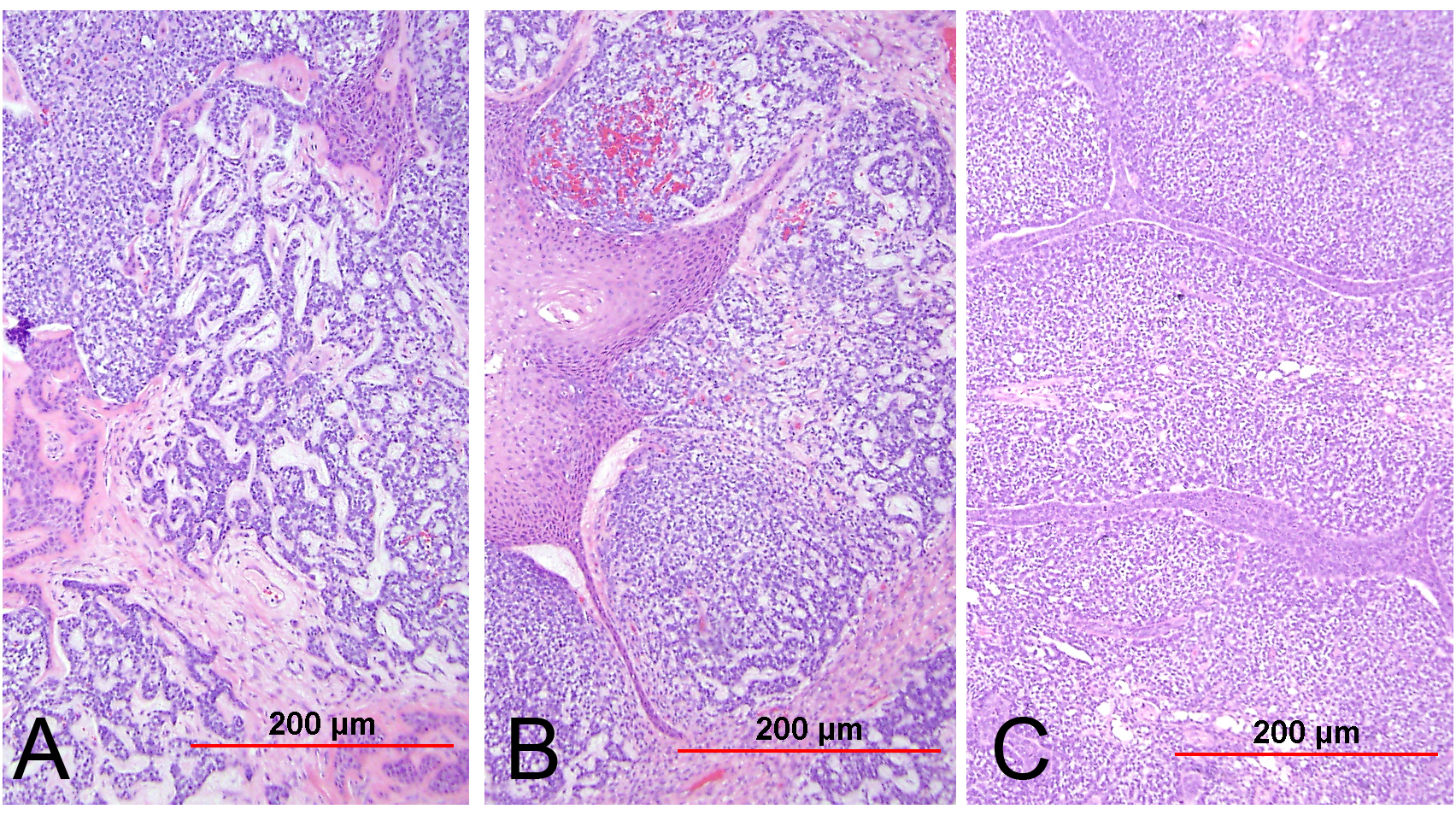 Aggressive undifferentiated carcinoma in the vagina