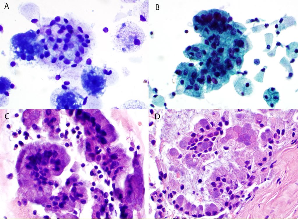 Active Chronic Cervicitis Squamous Metaplasia On Pap