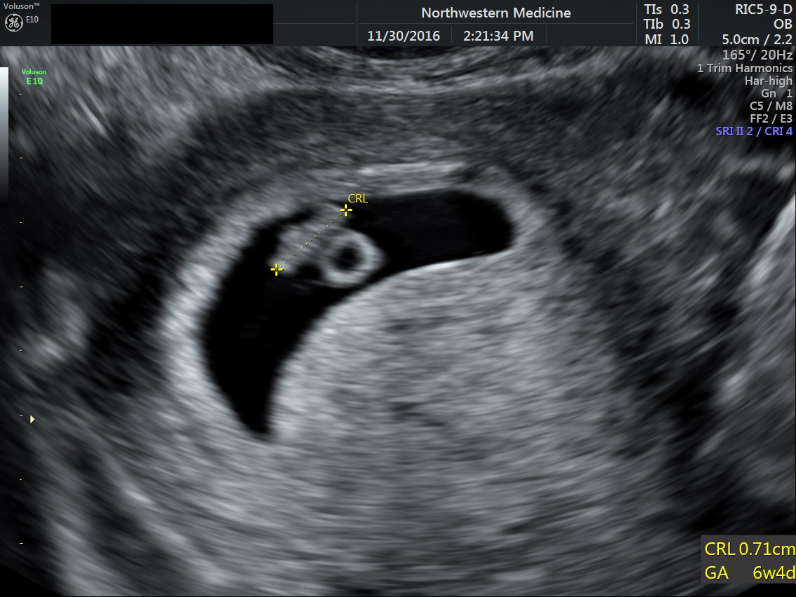 pregnancy-5-weeks-5-days-ultrasound-pregnancywalls