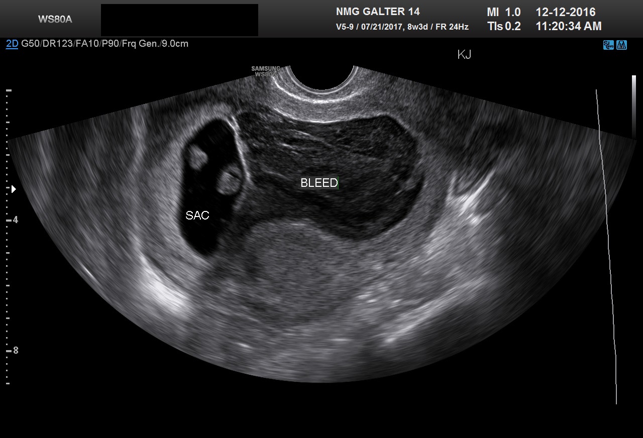 Subchorionic Hematoma Size Chart