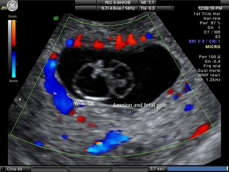 Diagnostic Ultrasound in the First Trimester of Pregnancy ...