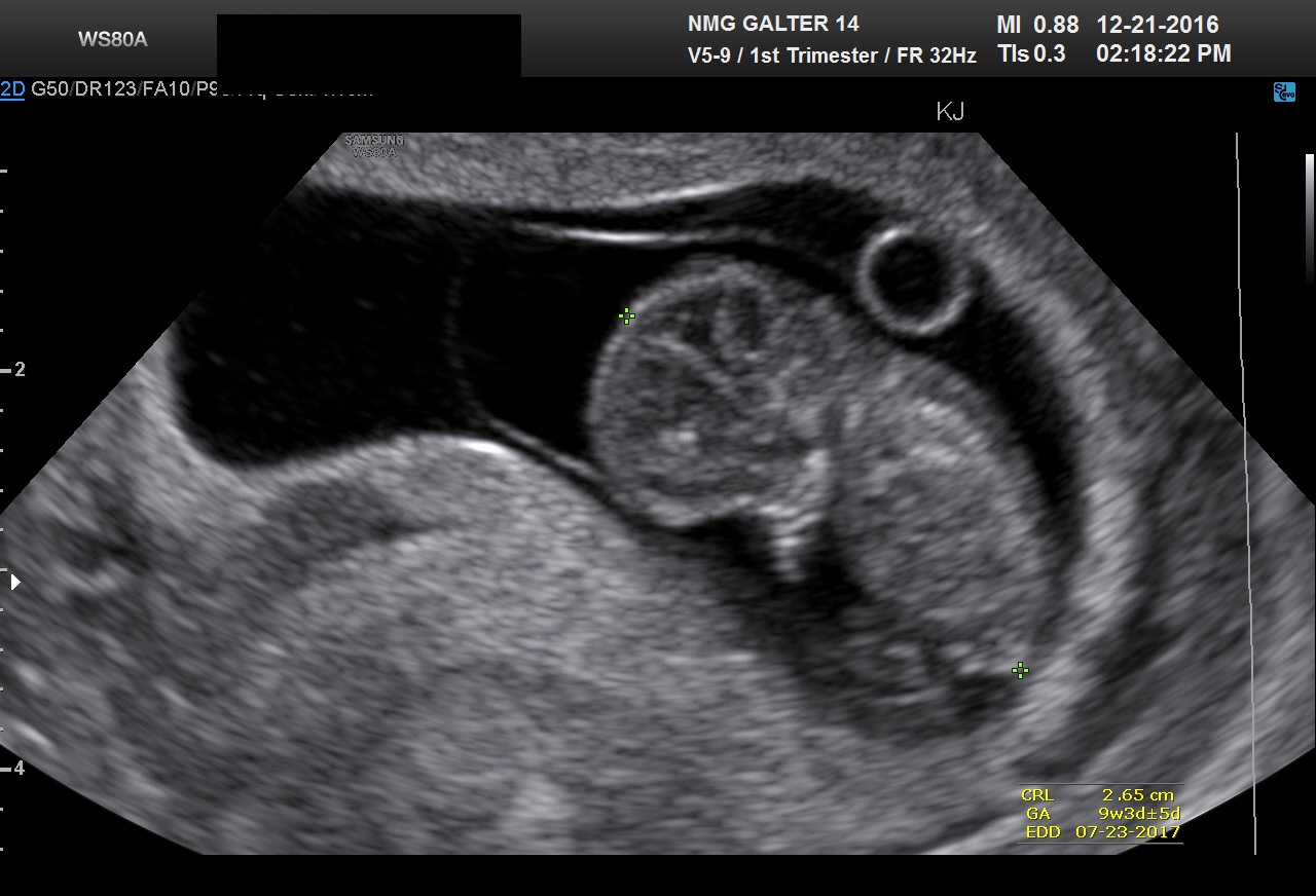 dating scan at 9 weeks
