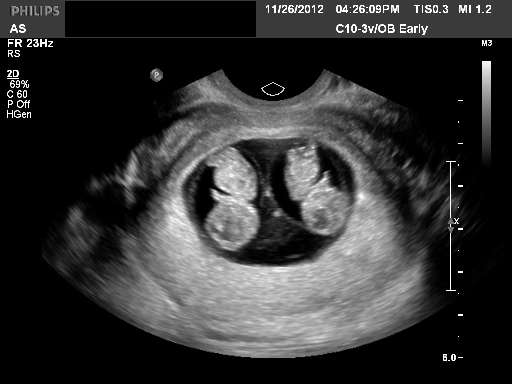 6 week 4d ultrasound pictures