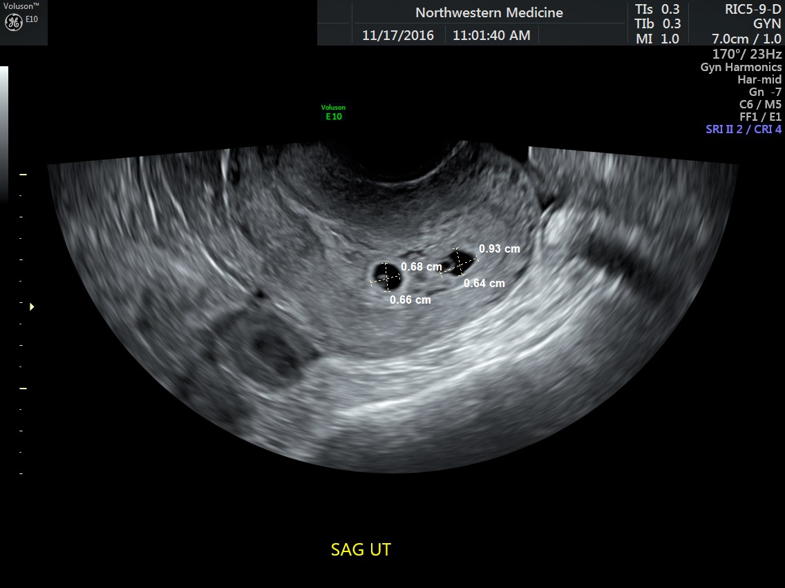 Dating Scan At 6 Weeks 