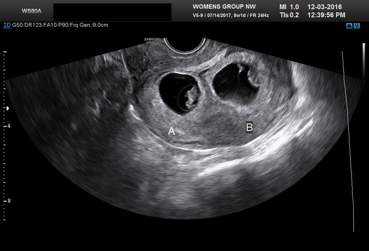 Diagnostic Ultrasound in the First Trimester of Pregnancy GLOWM