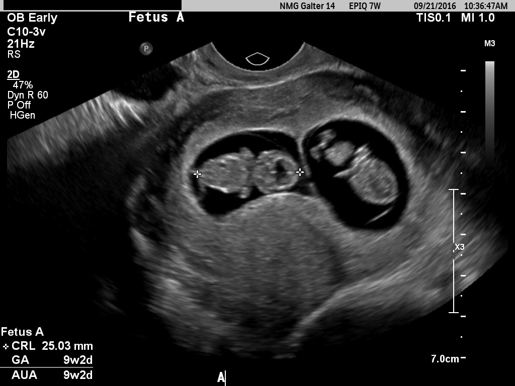 7 week sonogram