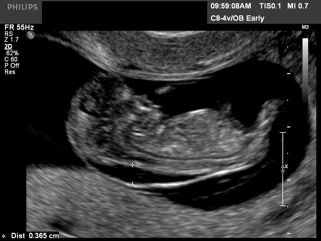 Diagnostic Ultrasound In The First Trimester Of Pregnancy Glowm