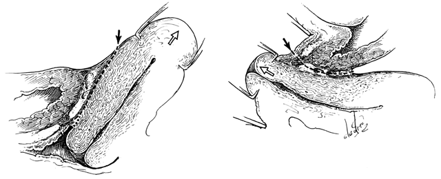 Clinical Anatomy of the Vulva, Vagina, Lower Pelvis, and Perineum