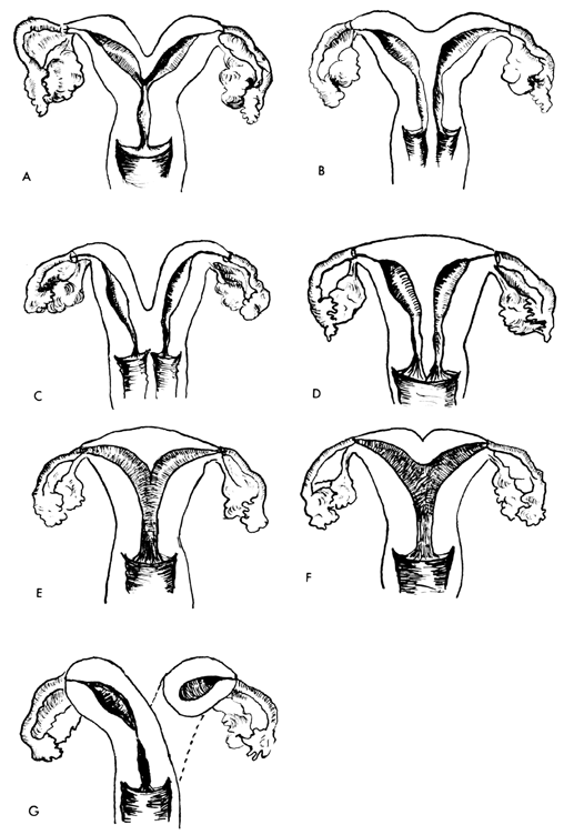 Vaginal prolapse in bladder exstrophy with complete duplication of the  uterus