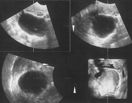 simple ovarian cyst ultrasound