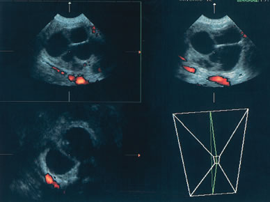 Diagnostic Ultrasound In The Assessment Of The Adnexal Mass Glowm