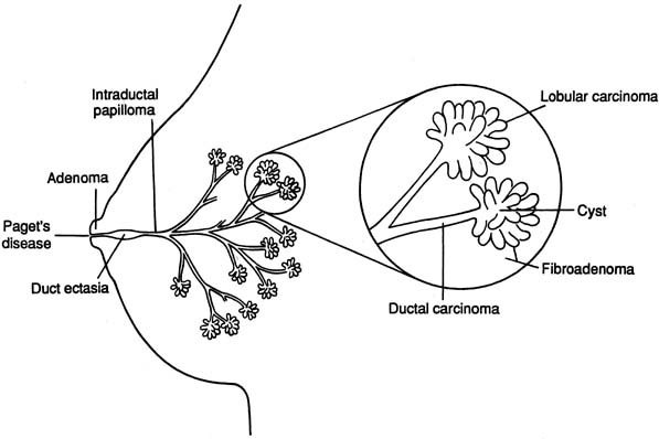 Diagnosis and Management of Benign Breast Disease