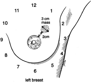 Diagnosis And Management Of Benign Breast Disease Glowm