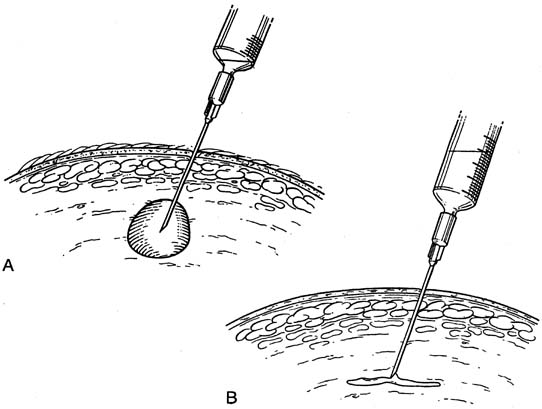 Nipple Discharge - The Breast Specialist, Kefah Mokbel, London