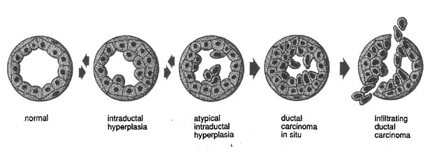 Benign Diffuse Breast Hyperplasia during Pregnancy