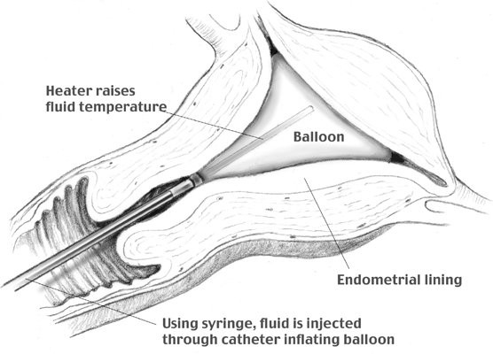 Endometrial Ablation GLOWM