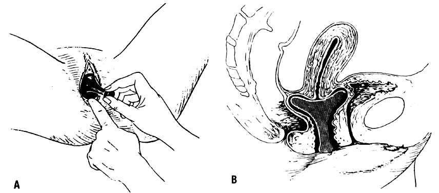 Pessary Fitting - Western Women's and Mens Health