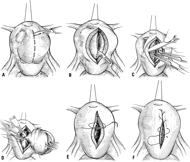 laparoscopic myomectomy procedure