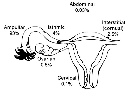 Ectopic Pregnancy Glowm