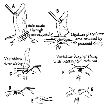 Appendiceal stump inversion with a purse-string suture in laparoscopic  appendectomy | Semantic Scholar