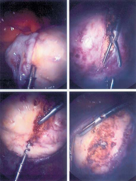 Laparoscopic Oophorectomy for Ovarian Torsion • Video •