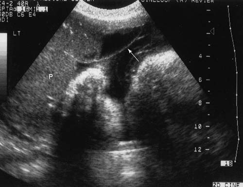 Kleihauer-betke test placental abruption on ultrasound bulls vs raptors odds