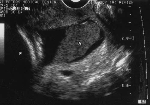 Kleihauer-betke test placental abruption on ultrasound forex charts how read