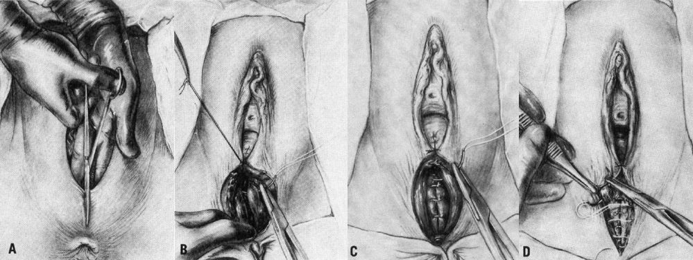 Episiotomy GLOWM