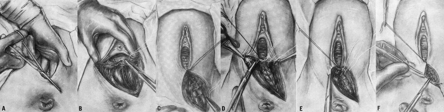 episiotomy-glowm